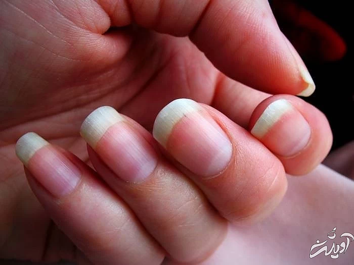 حکم کاشت ناخن